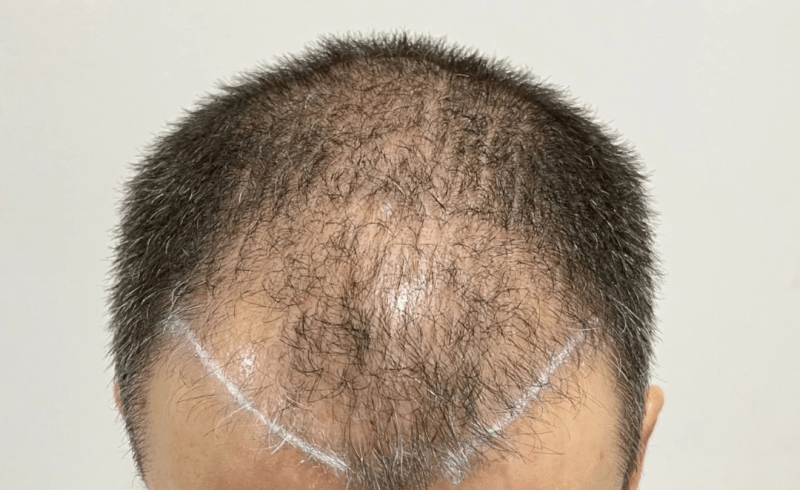 Before temple density example 2